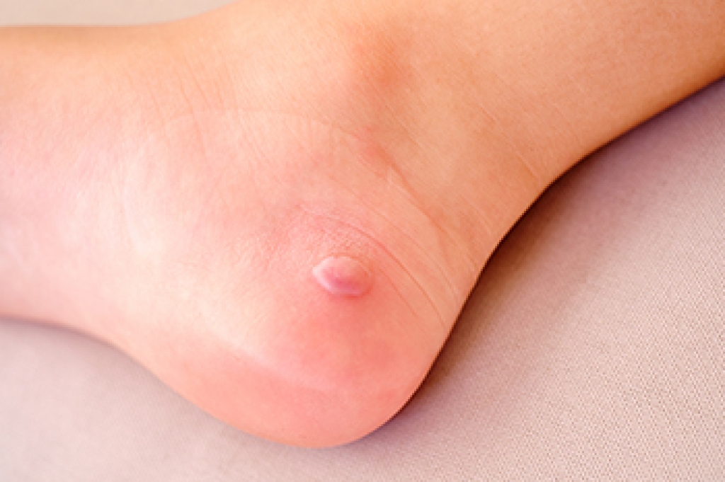 Facts About Diabetic Foot Blisters