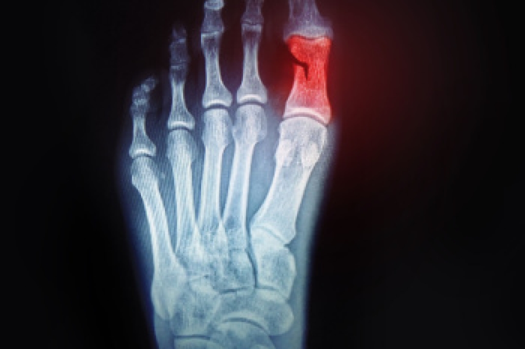 How Broken Toes Occur and When to Seek Care