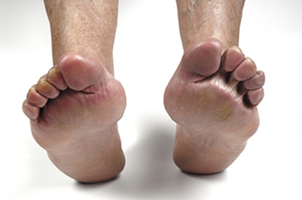 Living With Foot Pain in Chronic Conditions