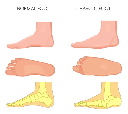charcot reconstruction