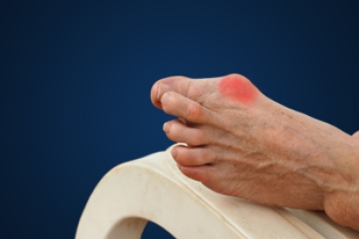 What You Need to Know About Bunion Removal