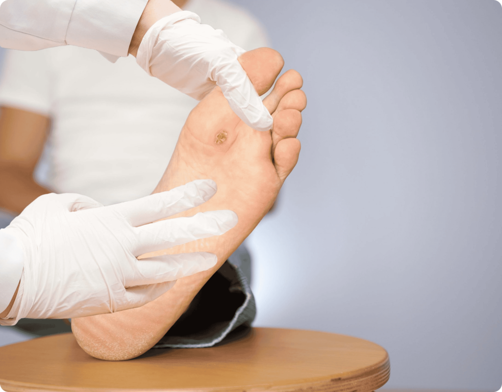 Wart removal with the swift device